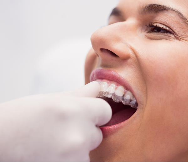 clear-dental-aligner-insertion