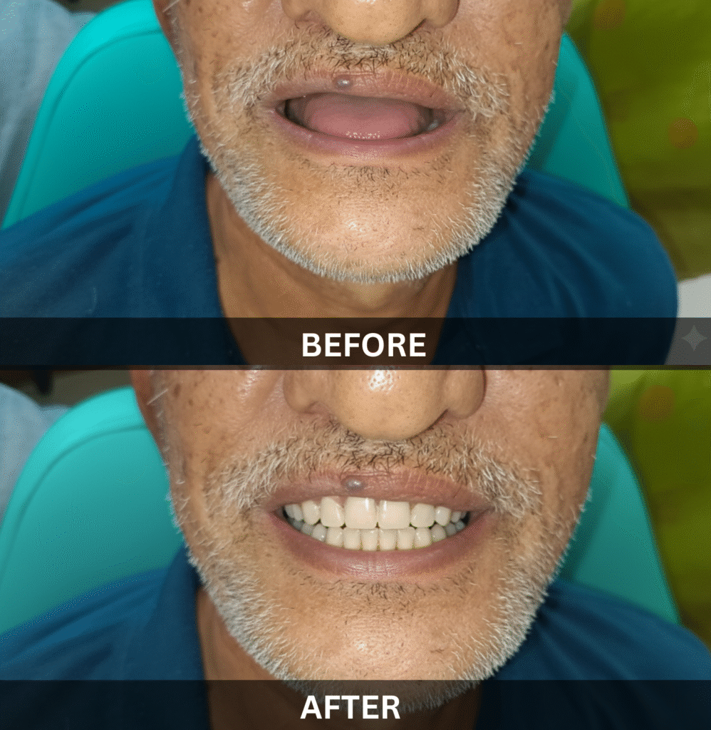 edentulous-jaw-full-mouth-restoration-before-after
