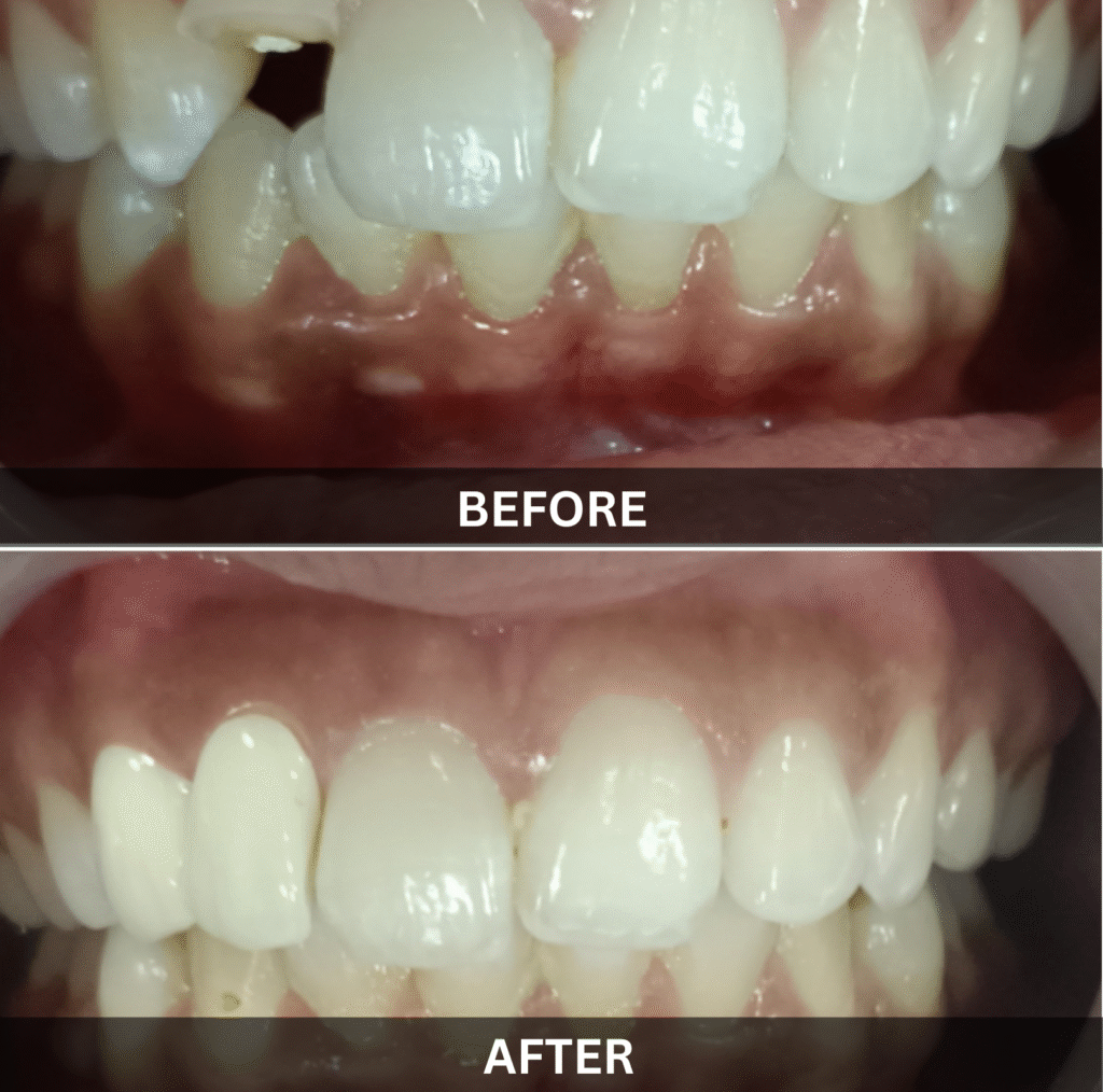 teeth-crowding-and-bonding-before-after