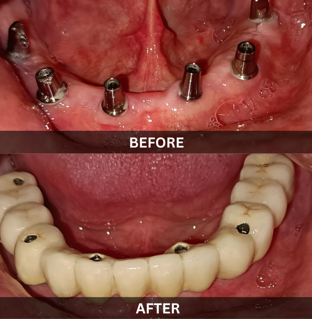 lower-arch-all-on-6-implants-before-after