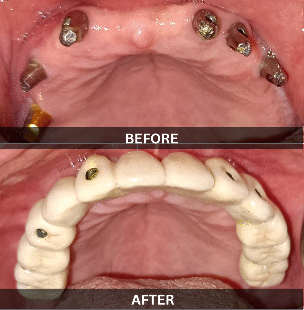 full-arch-dental-implant-restoration-top-view