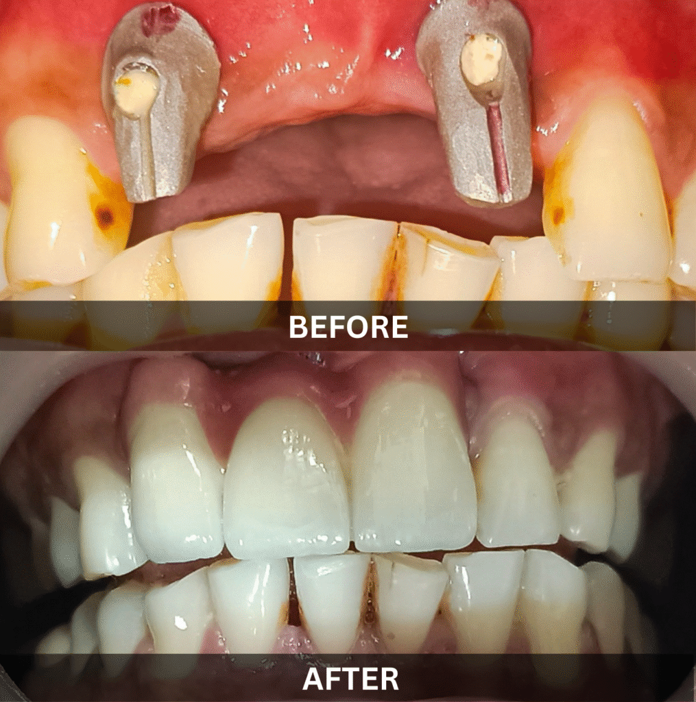 front-teeth-bridge-replacement-before-after
