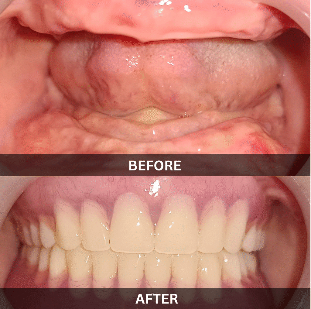 full-arch-rehabilitation-edentulous-jaw