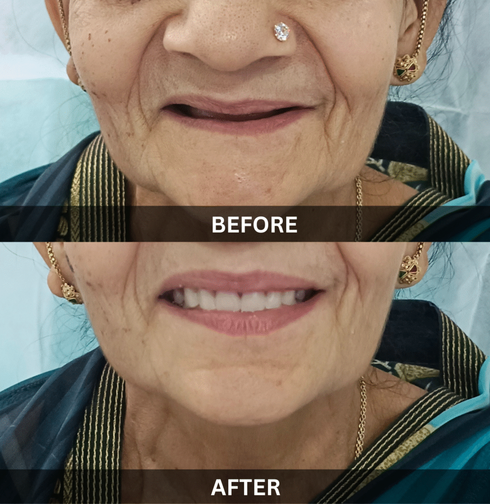 senior-smile-makeover-full-mouth-reconstruction