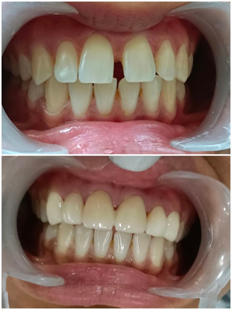 diastema-closure-veneers-before-after