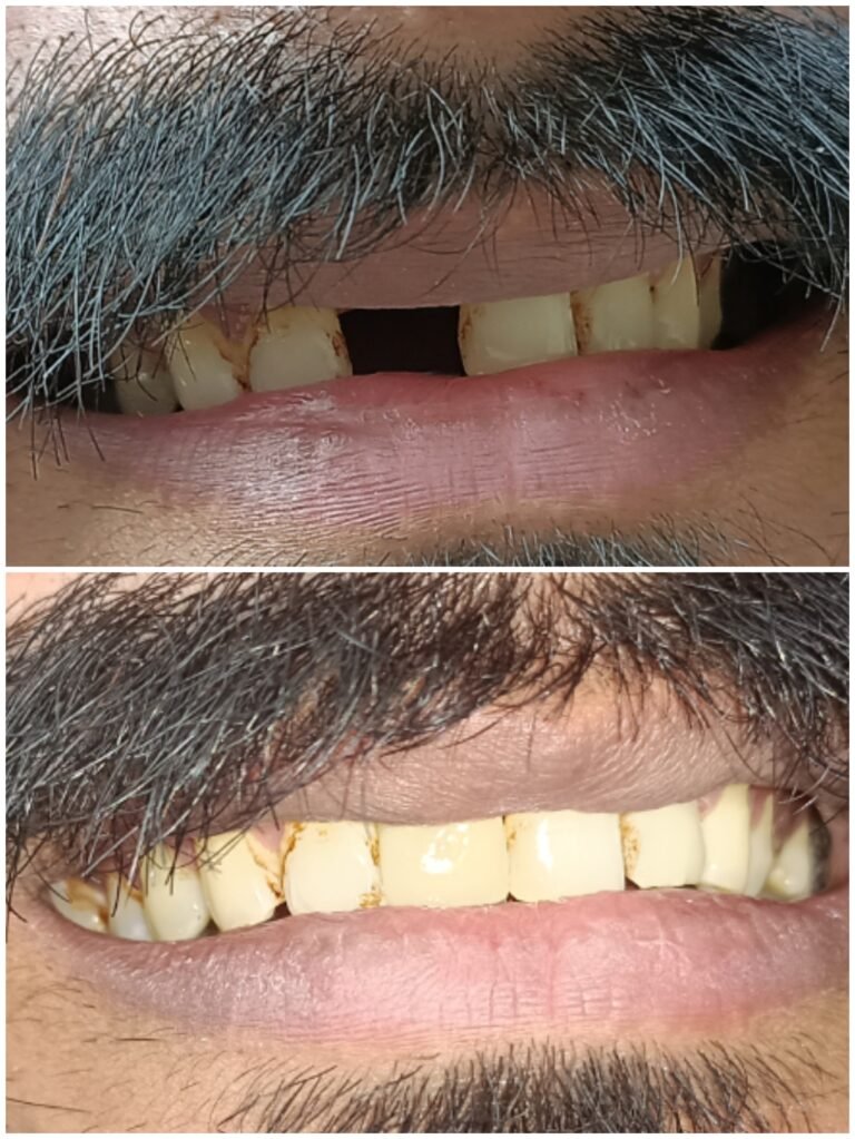 missing-front-teeth-replacement-bridge-before-after
