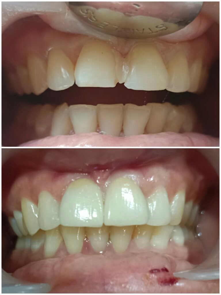 chipped-front-tooth-restoration-before-after