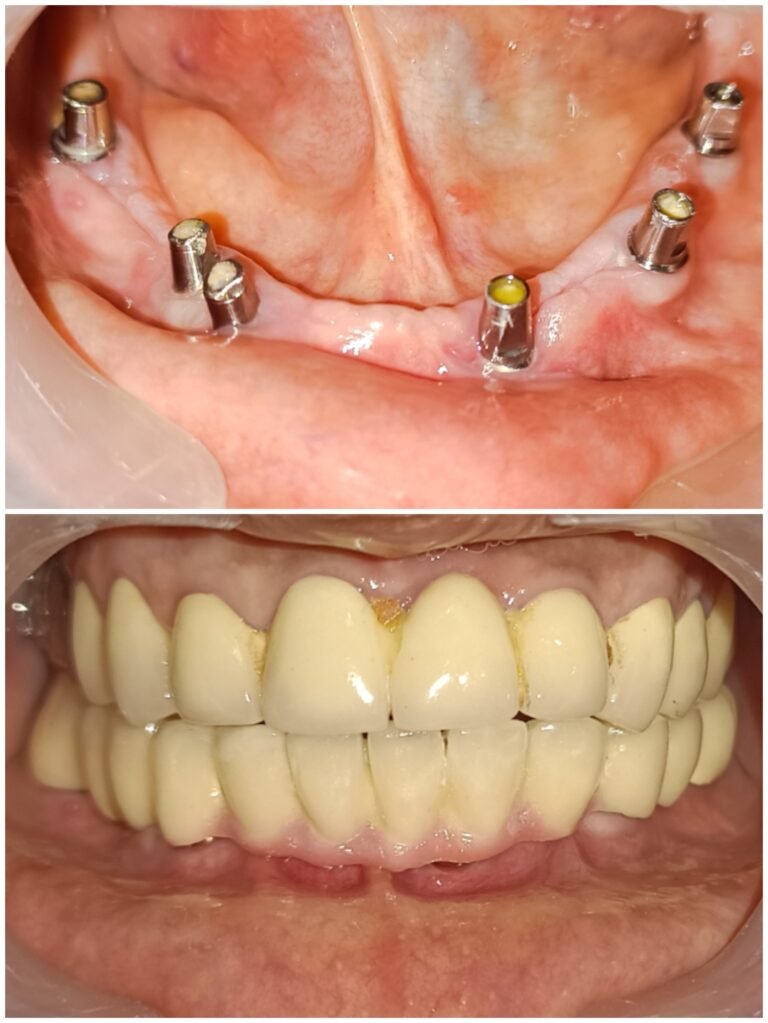 full-mouth-dental-implants-and-prosthesis-before-after