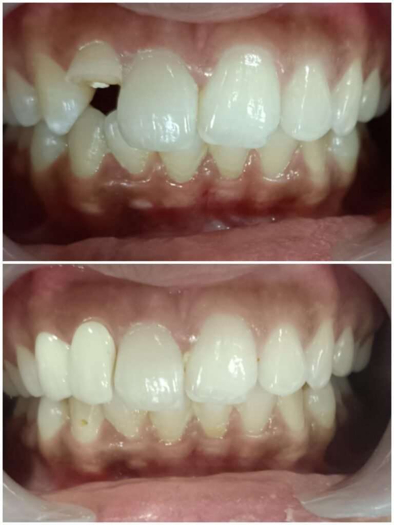 missing-or-fractured-front-tooth-replacement