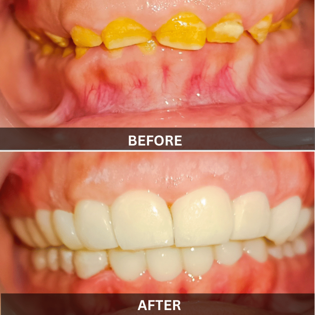 before-after-smile-transformation-severe-wear