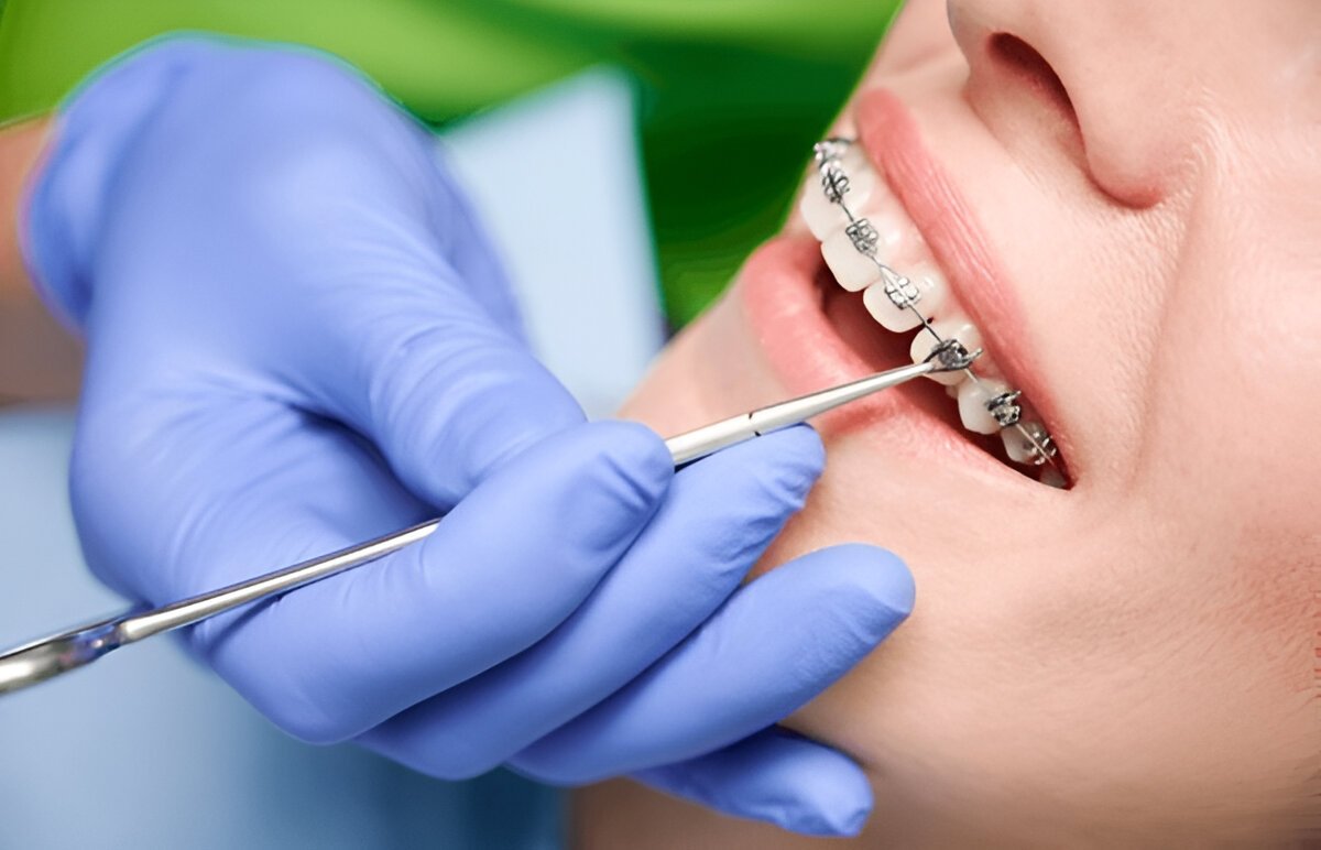 braces treatment in Gota
