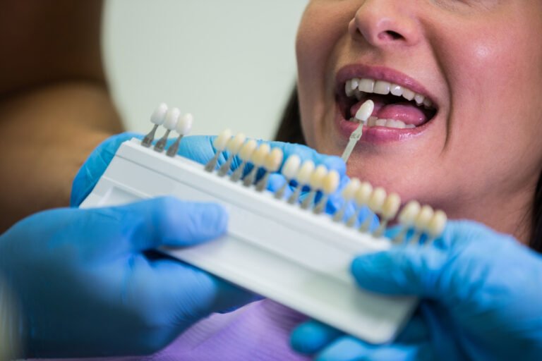 dentist-shade-matching-for-veneers-or-crowns