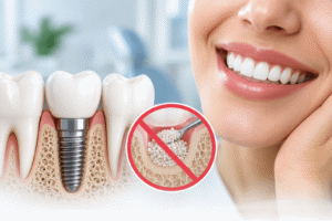 Dental Implants Without Bone Grafting
